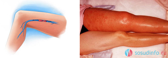 Симтомы, диагностика и лечение закупорки кровеносных сосудов