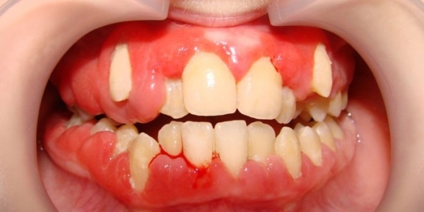 Гипертрофический гингивит