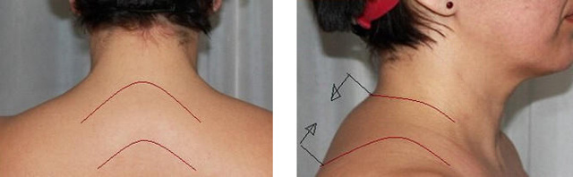 Как убрать горб на спине: эффективные способы лечения