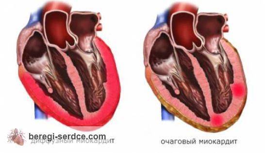 Почему болит где сердце – причины и возможные заболевания