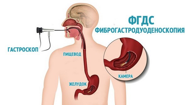 Кровотечение в кишечнике: симптомы, диагностика и способы лечения