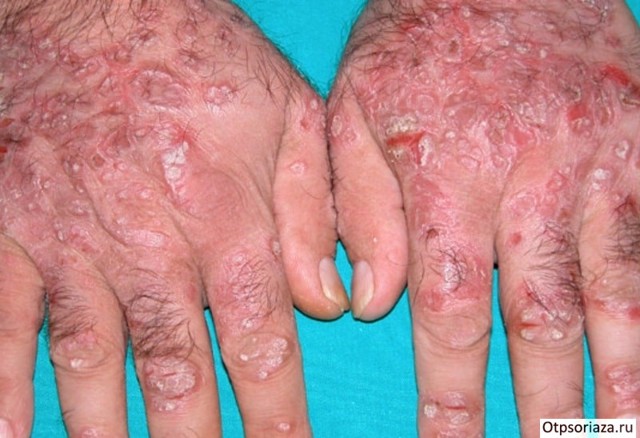 Лечение псориаз на руках - фото, симптомы, виды псориаза на руках