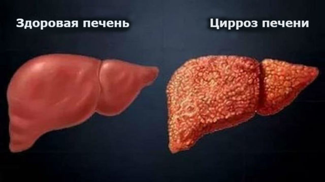 Что это значит - у взрослого повышен общий билирубин