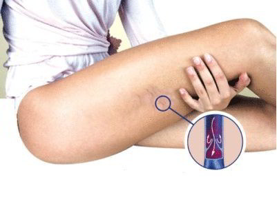 Тромб в ноге – причины, симптомы и лечение