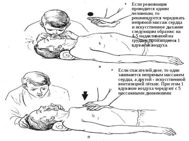 Что такое Непрямой массаж сердца?