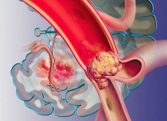 Флеболиты в малом тазу у мужчин - Все про холестерин