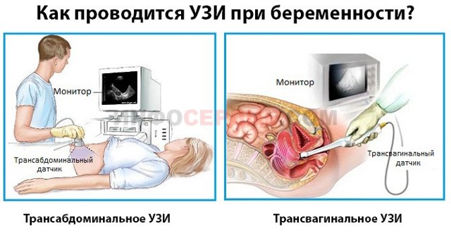 Трикуспидальная регургитация: степени, причины, лечение. Минимальная митральная регургитация что это такое