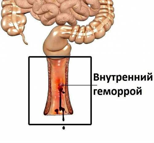 Выпал геморроидальный узел