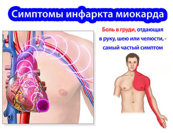 Гипертрофическая кардиомиопатия.