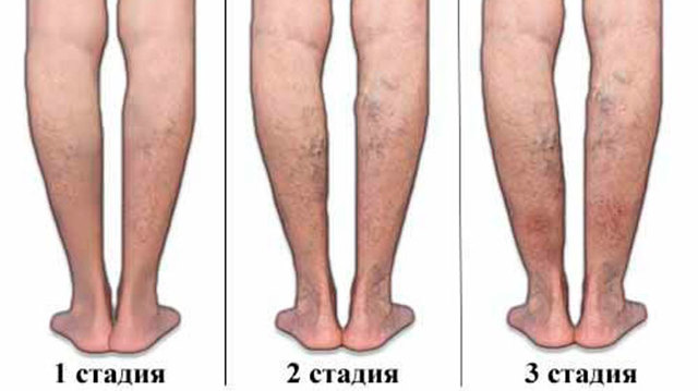 Вены на ногах лечение народными средствами, убрать варикоз за 7 дней