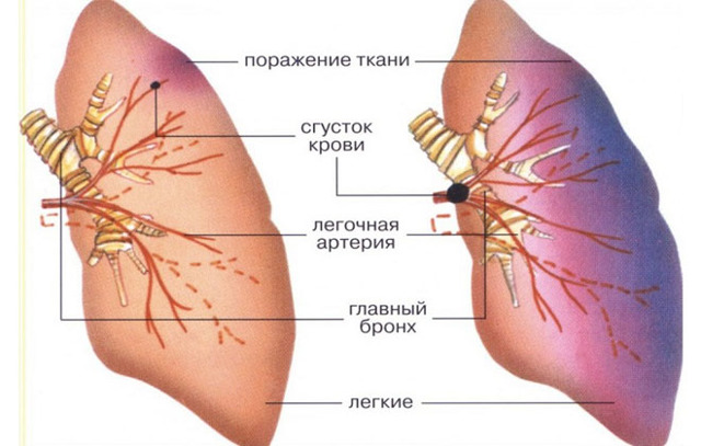 Тромбофлебит легких лечение