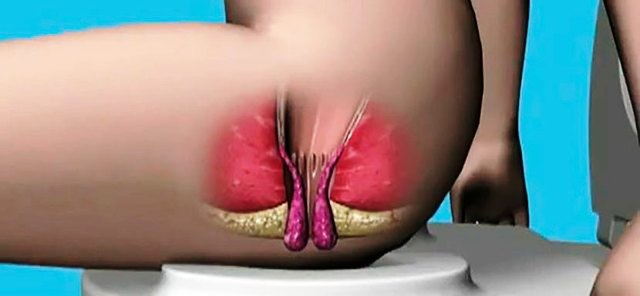 Геморрой при беременности - признаки, симптомы, причины и лечение