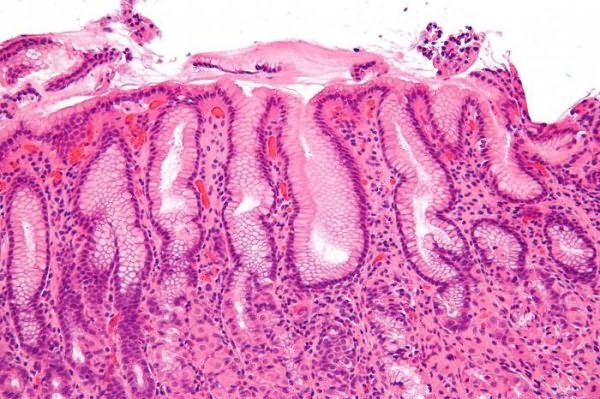 Эрозивный гастрит – симптомы, лечение, диета, осложнения, профилактика