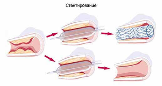 Нестенозирующий атеросклероз внечерепных отделов брахиоцефальных артерий - Всё о сердце
