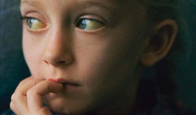 Повышенный билирубин – причины и симптомы билирубина, диагностика, лечение и профилактика