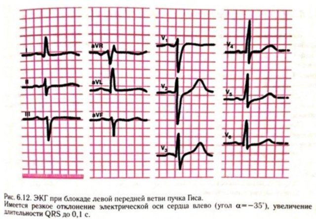 ЭКГ при блокаде правой ножки пучка Гиса (ПНПГ)