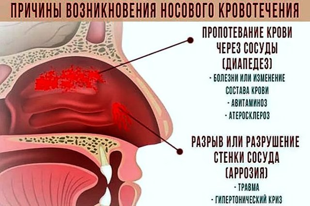 Кровь из носа: причины у взрослого и методы лечения дома