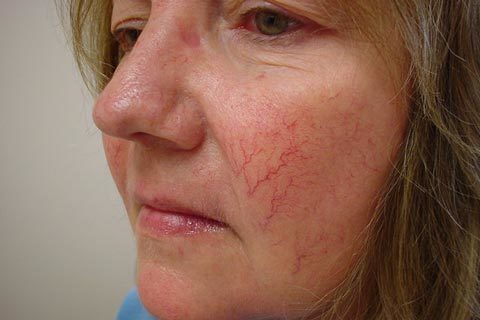 Как убрать красные сосуды на лице в домашних условиях