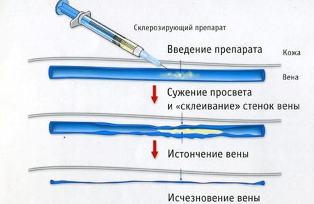 Склеротерапия вен нижних конечностей