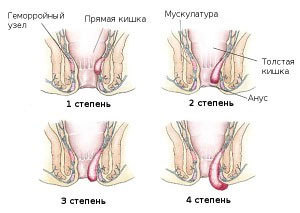 Геморрой - причины, симптомы, диагностика и лечение