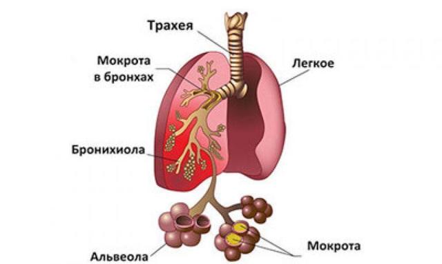 Пневмония на фоне сердечной недостаточности -