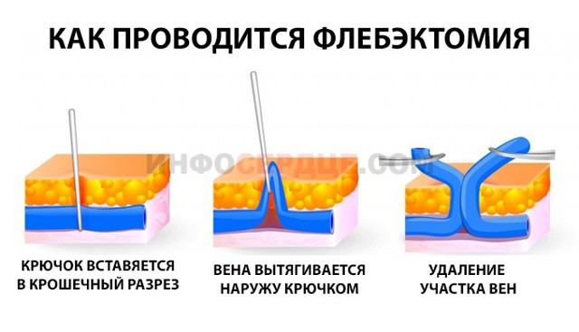 Кдо что это такое | Все о ретикулярном варикозе