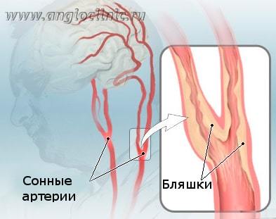 Атеросклеротические стенозы сонных артерий как причина мозгового инсульта - Сибирский медицинский портал