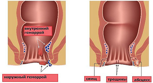 Удаление геморроя – современные операции