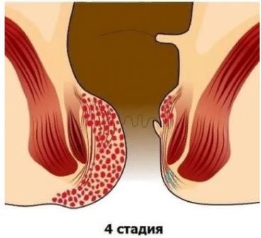 Острый геморрой: чем снять и как лечить
