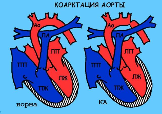 Операция при пороке сердца у ребенка как проходит -