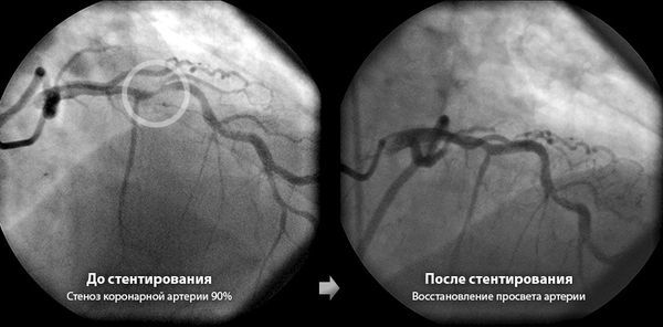 Современные способы хирургического лечения заболеваний сердца