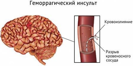 Критические дни после инсульта