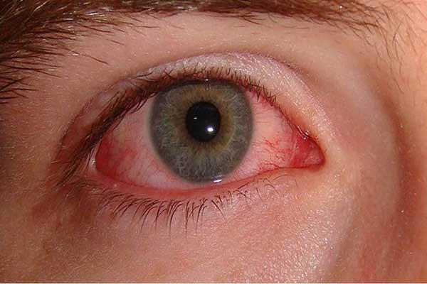 Васкулит мозга