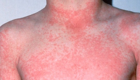 Красные пятна на теле у взрослого - появились красные пятнышки на лице