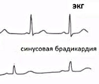 Брадикардия - причины, признаки, симптомы и лечение