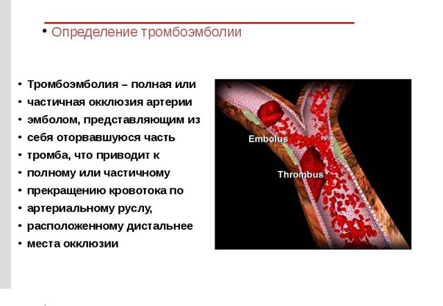 Тромбоэмболия - что это такое: признаки, диагностика и профилактика