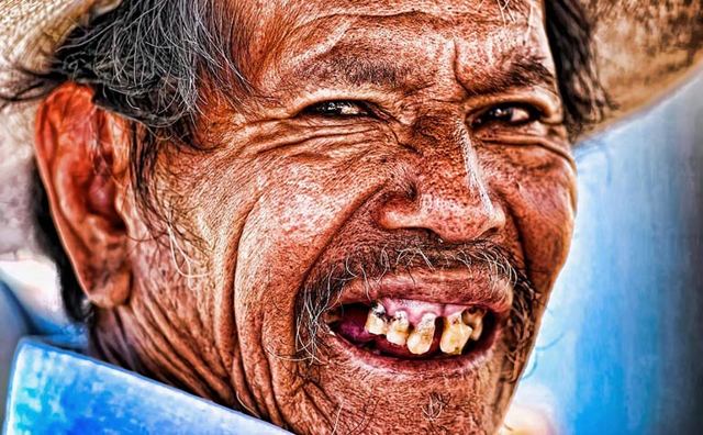 Пришеечный кариес - причины, симптомы, диагностика и лечение