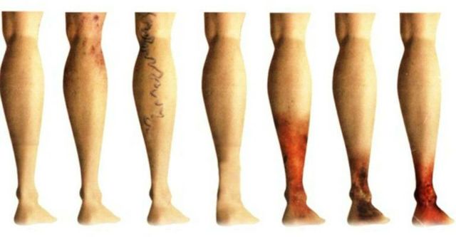 Варикоз, варикозное расширение вен ног: лечение, симптомы