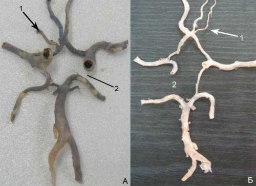 Внутренняя сонная артерия