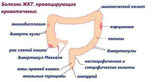 Кровотечение в кишечнике: симптомы, диагностика и способы лечения