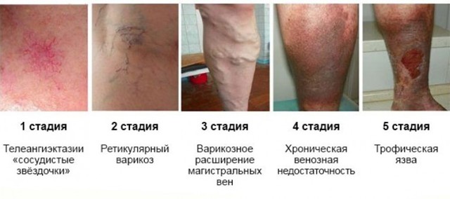 Симптомы варикозного расширения вен на ногах, степени и стадии варикоза