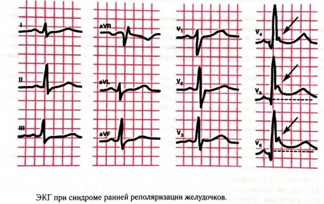 Нарушение процессов реполяризации в миокарде