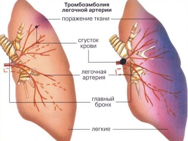 Гипертрофия правого предсердия на ЭКГ: симптомы перегрузки сердца