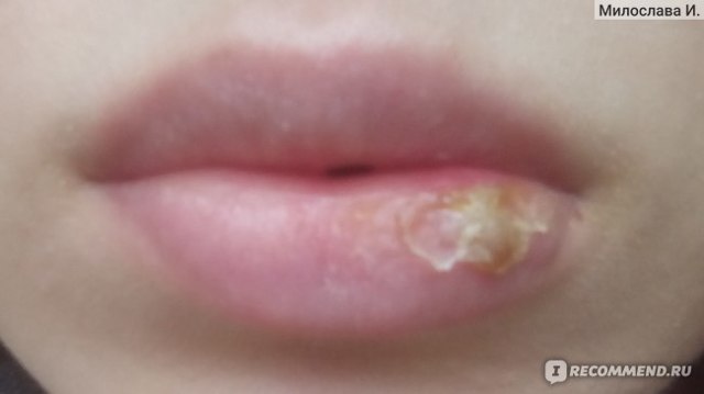 Гемангиома на лице: лечение, фото на губе и носу, причины и удаление