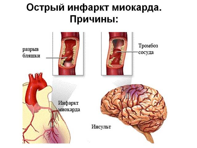 Признаки инфаркта миокарда передней стенки на ЭКГ