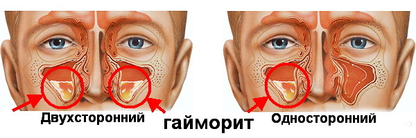 Острый гайморит - симптомы и лечение, прогноз