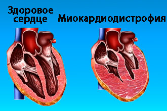 Симптомы и лечение дистрофии миокарда