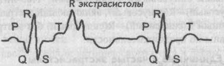 Монотопные экстрасистолы