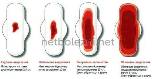 Большие сгустки при месячных: что выходит с кровью?