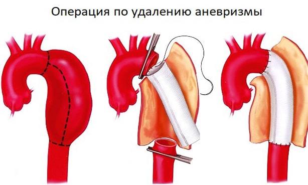 Операция на сонной артерии при атеросклерозе